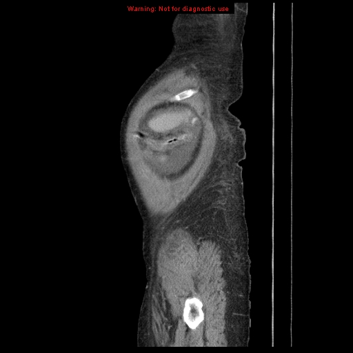 Abdominal wall hematoma (Radiopaedia 9427-10112 Sagittal C+ portal venous phase 10).jpg