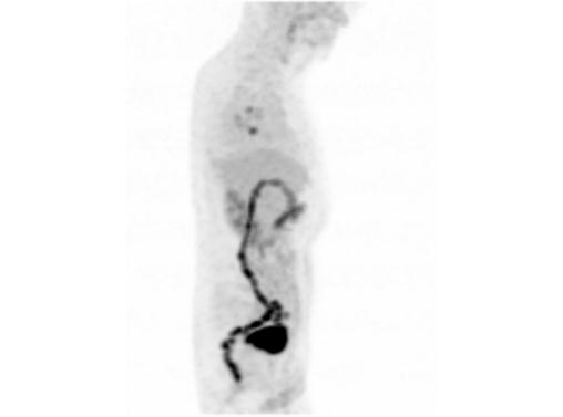 File:Abdominal wall metastasis from colorectal carcinoma (Radiopaedia 31016-31719 Rotational MIP 23).jpg