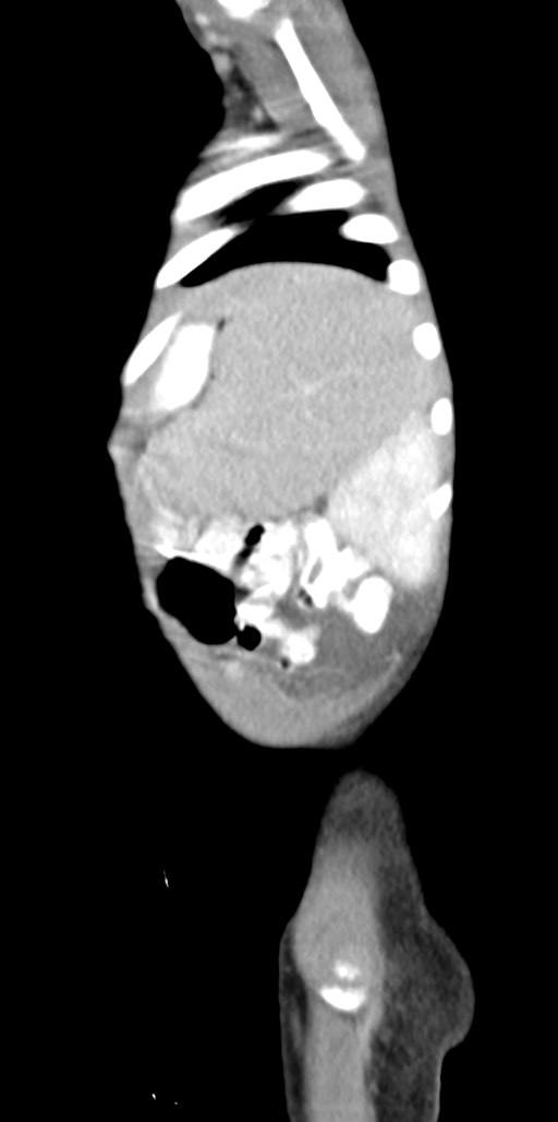 Abdominopelvic rhabdomyosarcoma (Radiopaedia 78356-90984 Sagittal C+ portal venous phase 14).jpg