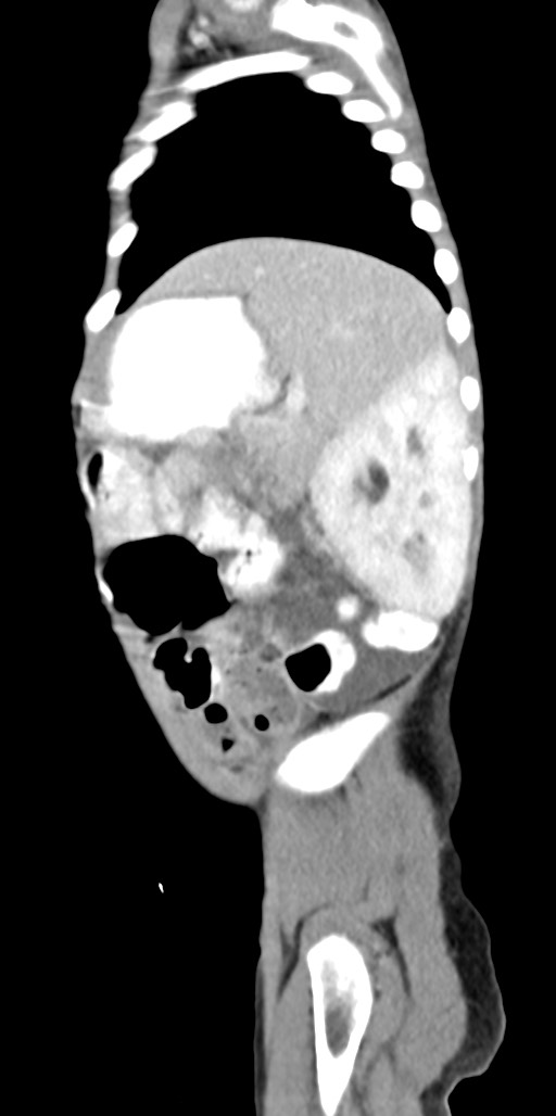 Abdominopelvic rhabdomyosarcoma (Radiopaedia 78356-90984 Sagittal C+ portal venous phase 20).jpg