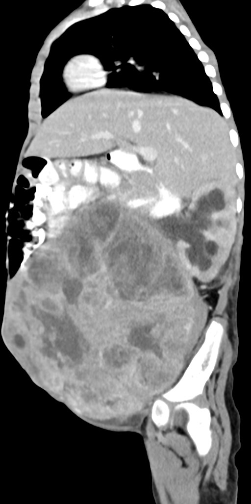 Abdominopelvic rhabdomyosarcoma (Radiopaedia 78356-90984 Sagittal C+ portal venous phase 63).jpg