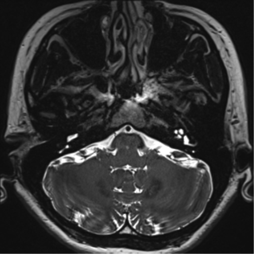 Abducens nerve palsy (Radiopaedia 51069-56648 Axial T2 fat sat 13).png