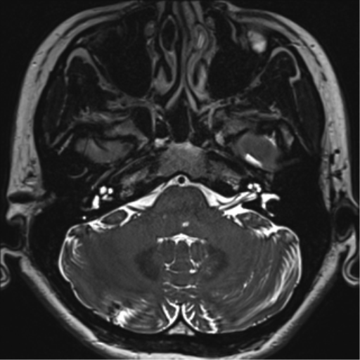 Abducens nerve palsy (Radiopaedia 51069-56648 Axial T2 fat sat 17).png