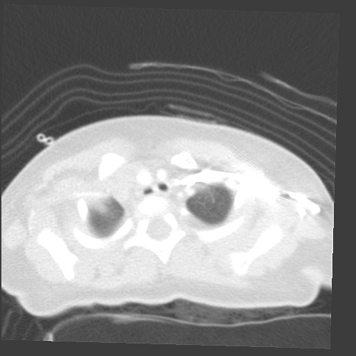 File:Aberrant left pulmonary artery (pulmonary sling) (Radiopaedia 42323-45435 Axial lung window 4).jpg