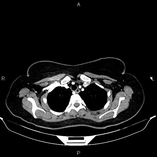 Aberrant right subclavian artery (Radiopaedia 87334-103629 Axial C+ arterial phase 15).jpg