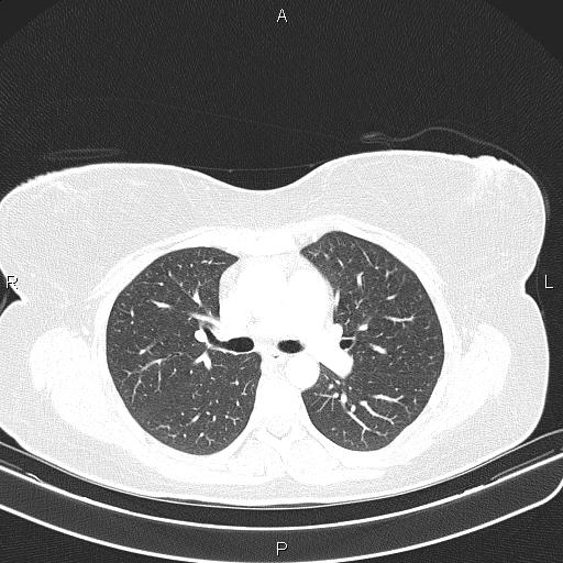 File:Aberrant right subclavian artery (Radiopaedia 87334-103629 Axial lung window 29).jpg