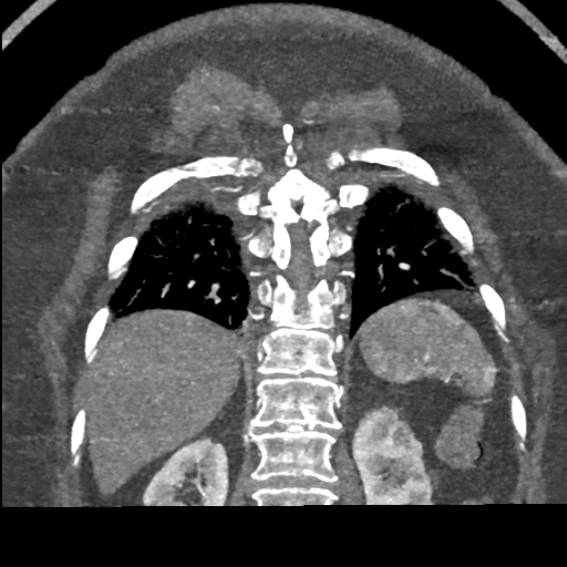 File:Aberrant right subclavian artery with Kommerell diverticulum (Radiopaedia 47982-52769 Coronal C+ arterial phase 66).png