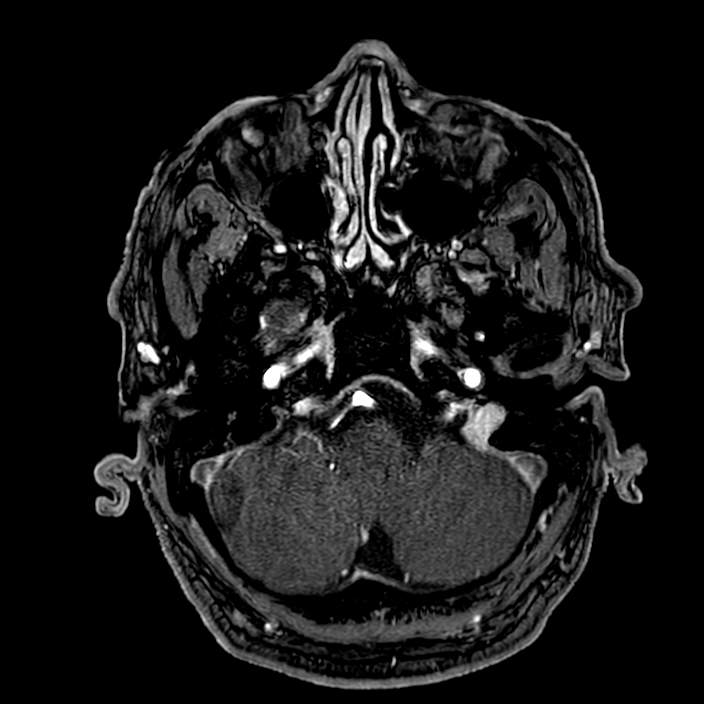 Accessory middle cerebral artery (Radiopaedia 73114-83828 Axial MRA 23).jpg