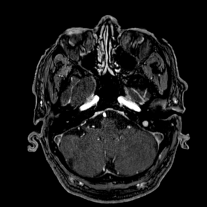 Accessory middle cerebral artery (Radiopaedia 73114-83828 Axial MRA 29).jpg