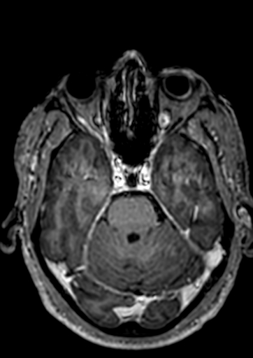 File:Accessory middle cerebral artery (Radiopaedia 73114-83828 Axial T1 C+ 102).jpg