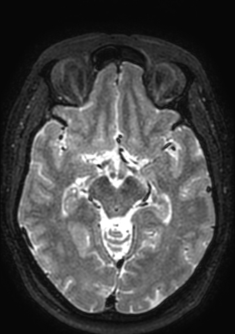 Accessory middle cerebral artery (Radiopaedia 73114-83828 Axial T2 103).jpg