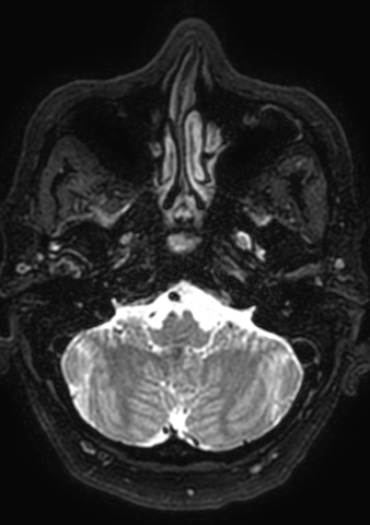 Accessory middle cerebral artery (Radiopaedia 73114-83828 Axial T2 184).jpg