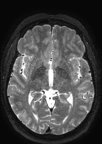 File:Accessory middle cerebral artery (Radiopaedia 73114-83828 Axial T2 85).jpg