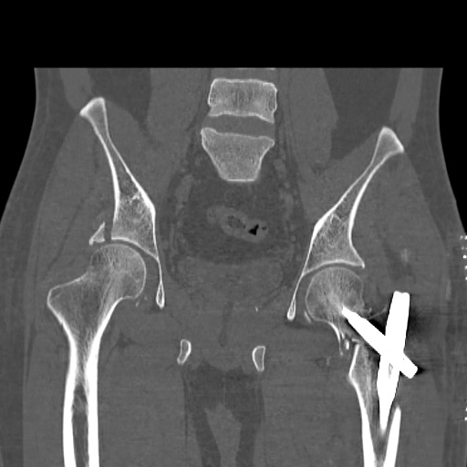 Acetabular and ilial fractures (Radiopaedia 59084-66378 Coronal bone window 29).jpg