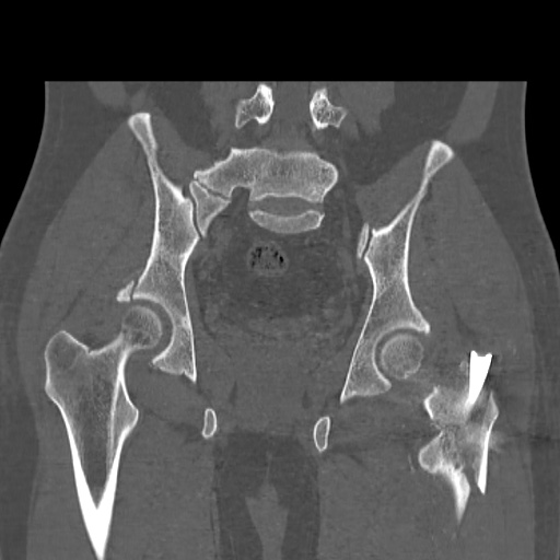 Acetabular and ilial fractures (Radiopaedia 59084-66378 Coronal bone window 33).jpg