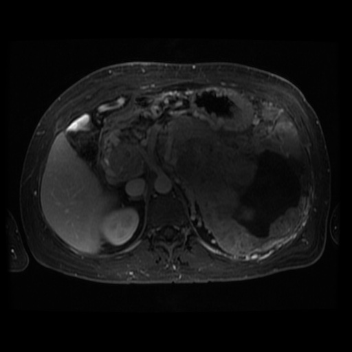 Acinar cell carcinoma of the pancreas (Radiopaedia 75442-86668 D 70).jpg