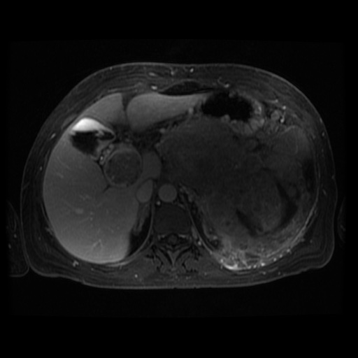 Acinar cell carcinoma of the pancreas (Radiopaedia 75442-86668 D 85).jpg