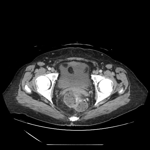 Acinar cell carcinoma of the pancreas (Radiopaedia 75442-86669 Axial C+ portal venous phase 138).jpg