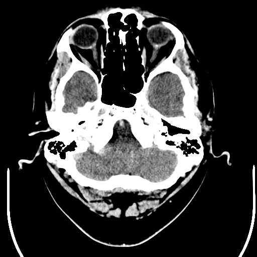 File:Acoustic schwannoma (Radiopaedia 39170-41389 Axial C+ 4).png