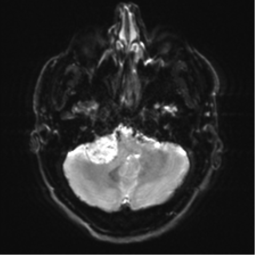 File:Acoustic schwannoma (Radiopaedia 50846-56358 Axial DWI 6).png