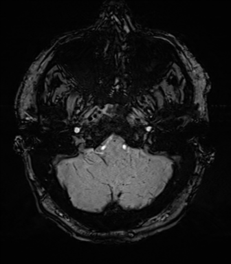 Acoustic schwannoma (Radiopaedia 50846-56358 Axial SWI 14).png