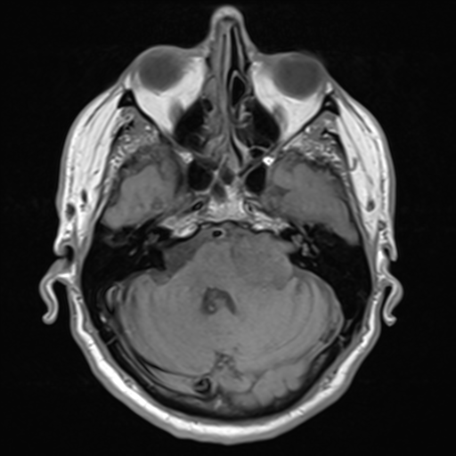 File:Acoustic schwannoma (Radiopaedia 55729-62281 T1 7).png