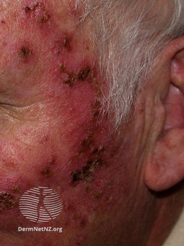 Actinic Keratoses treated with imiquimod (DermNet NZ lesions-ak-imiquimod-3771).jpg