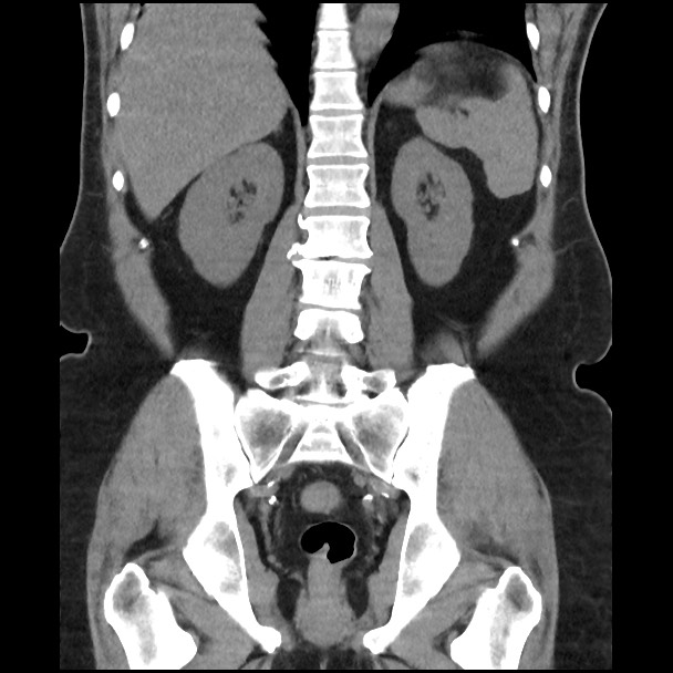 Active colonic bleed on CT (Radiopaedia 49765-55025 Coronal non-contrast 38).jpg