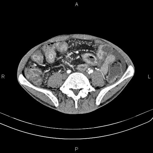 Active crohn disease (Radiopaedia 87133-103397 Axial C+ arterial phase 68).jpg