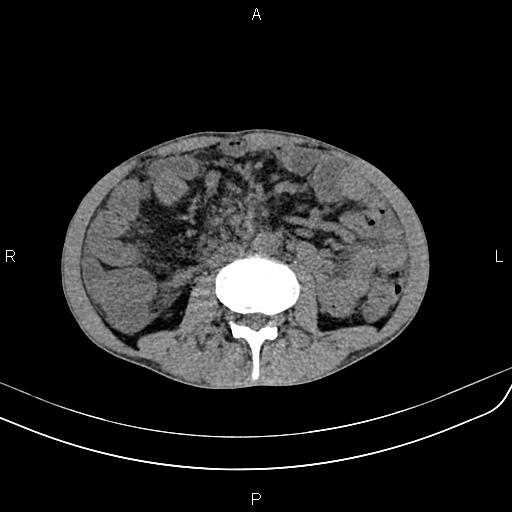Active crohn disease (Radiopaedia 87133-103397 Axial non-contrast 52).jpg