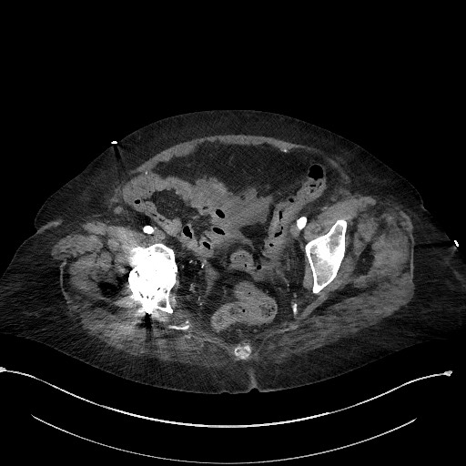File:Active renal extravasation with large subcapsular and retroperitoneal hemorrhage (Radiopaedia 60975-68796 Axial 126).jpg