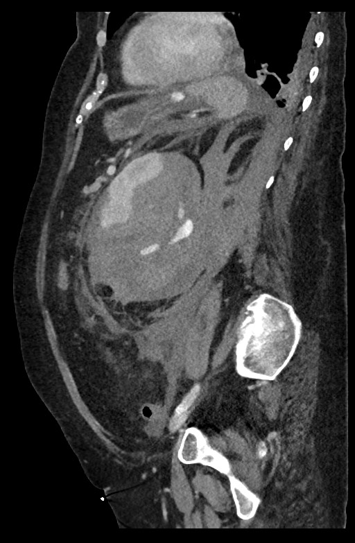 Active renal extravasation with large subcapsular and retroperitoneal hemorrhage (Radiopaedia 60975-68796 Sagittal C+ portal venous phase 84).jpg