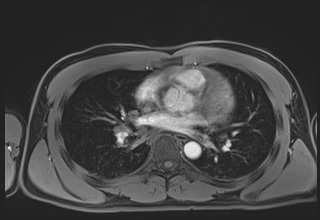 File:Active right ventricular cardiac sarcoidosis (Radiopaedia 55596-62100 Axial Post contrast Dixon 37).jpg