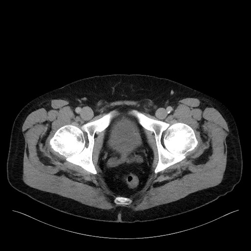 Acute-on-chronic pancreatitis (Radiopaedia 67286-76656 Axial C+ portal venous phase 80).jpg
