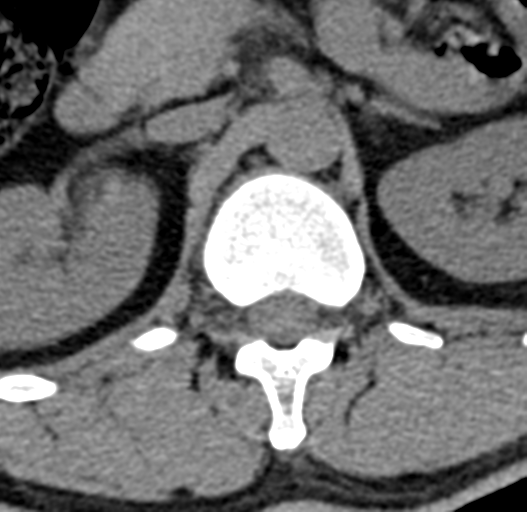File:Acute L1 burst compression fracture (Radiopaedia 34430-35755 Axial non-contrast 15).png