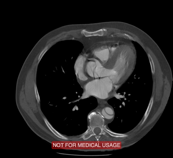 Acute aortic dissection - Stanford type A (Radiopaedia 40661-43285 Axial C+ arterial phase 41).jpg