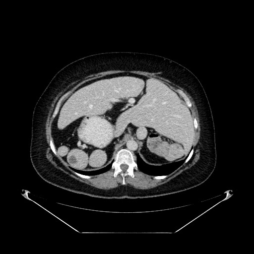 File:Acute appendicitis, heterotaxy syndrome (Radiopaedia 66884-76202 Axial 85).jpg
