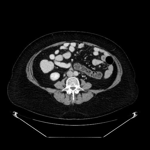 File:Acute appendicitis, heterotaxy syndrome (Radiopaedia 66884-76202 Axial C+ portal venous phase 73).jpg
