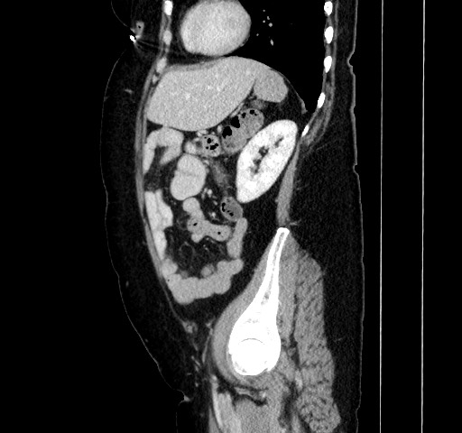 File:Acute appendicitis, heterotaxy syndrome (Radiopaedia 66884-76202 Sagittal C+ portal venous phase 96).jpg