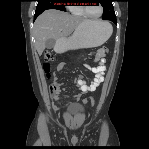 File:Acute appendicitis (Radiopaedia 10498-10973 F 2).jpg