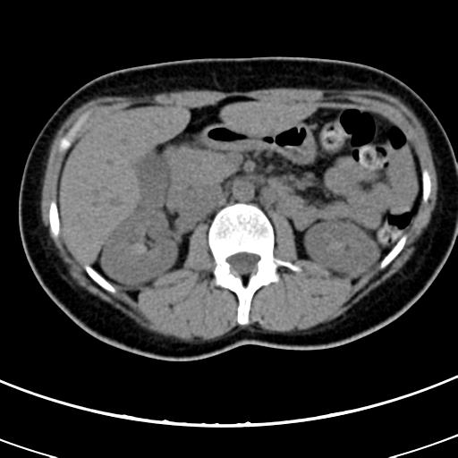 Acute appendicitis (Radiopaedia 30261-30888 Axial non-contrast 24).jpg