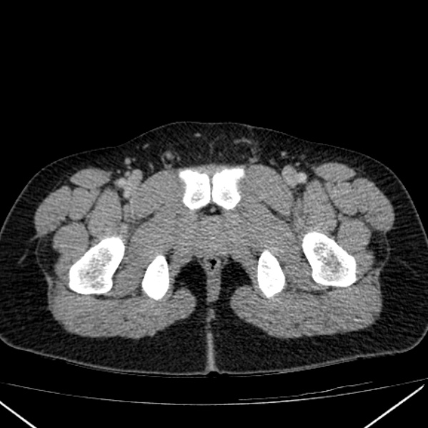 Acute appendicitis (Radiopaedia 38255-40270 Axial C+ portal venous phase 116).jpg