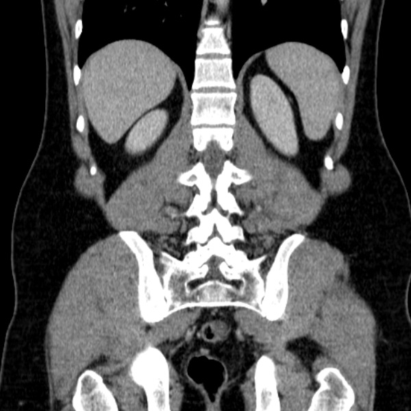 Acute appendicitis (Radiopaedia 38255-40270 Coronal C+ portal venous phase 64).jpg