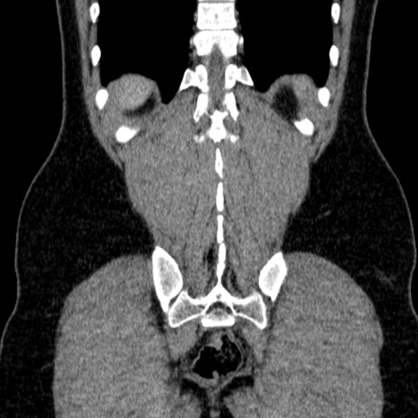 Acute appendicitis (Radiopaedia 38255-40270 Coronal C+ portal venous phase 73).jpg