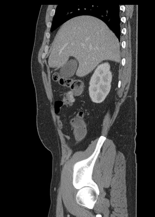 Acute appendicitis (Radiopaedia 48511-53463 Sagittal C+ portal venous phase 41).jpg