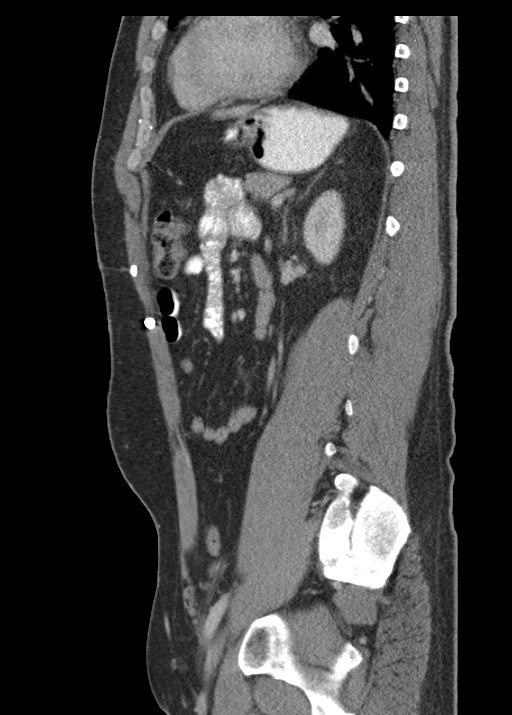 Acute appendicitis (Radiopaedia 48511-53463 Sagittal C+ portal venous phase 88).jpg