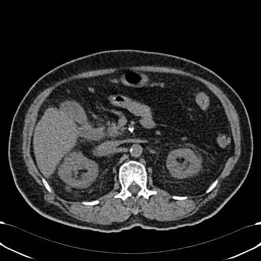Acute appendicitis (Radiopaedia 58627-65818 Axial non-contrast 32).jpg