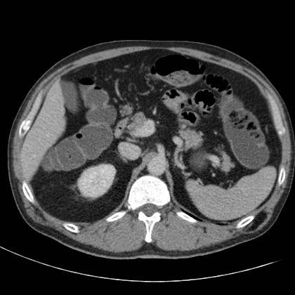 File:Acute appendicitis (Radiopaedia 66513-75790 Axial C+ portal venous phase 16).jpg