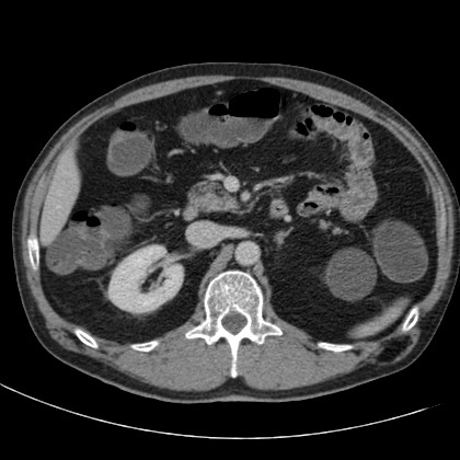 Acute appendicitis (Radiopaedia 66513-75790 Axial C+ portal venous phase 22).jpg