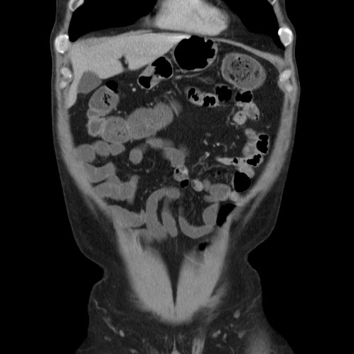 Acute appendicitis (Radiopaedia 66513-75790 Coronal C+ portal venous phase 8).jpg